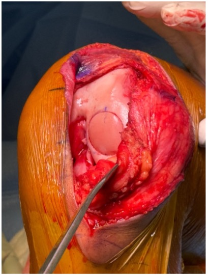 Procedimiento abierto de reconstrucción de rodilla