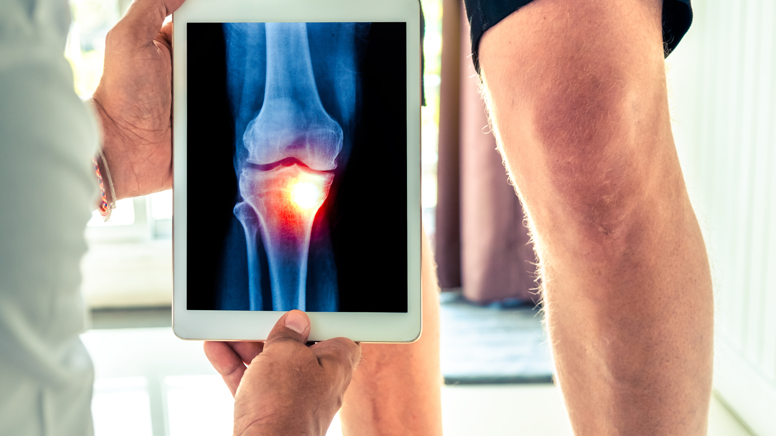 Introducción a Rodilla